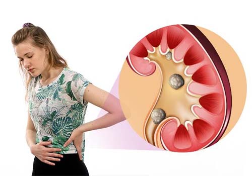 Kidney Stone Treatment