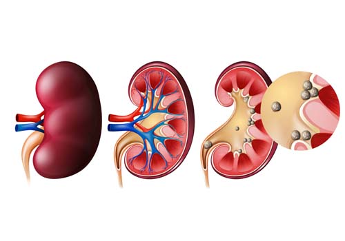 Kidney Stone Treatment