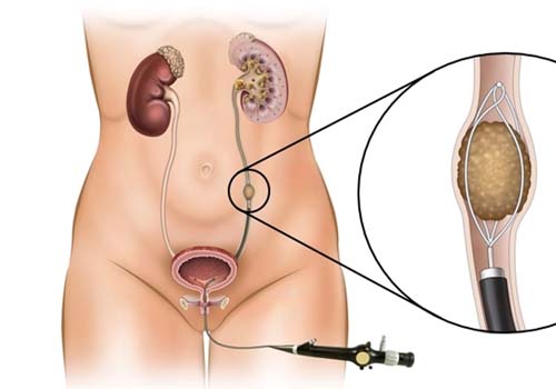 Kidney Stone Treatment