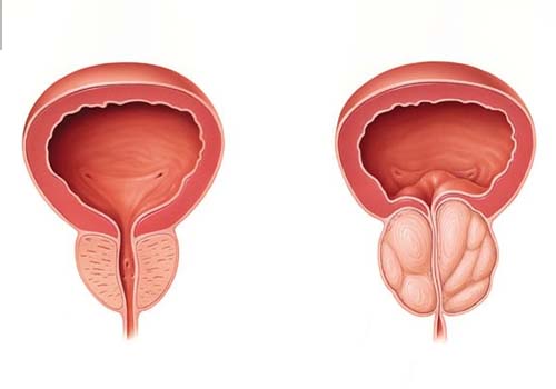Kidney Stone Treatment