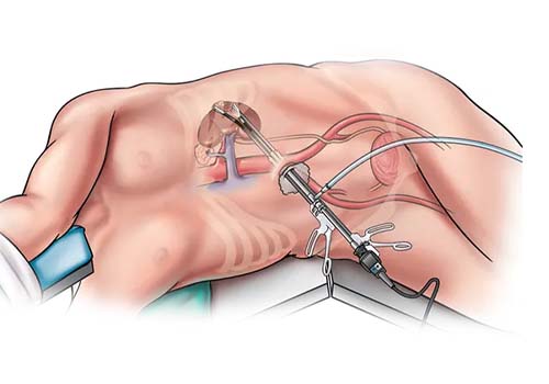 Kidney Stone Treatment