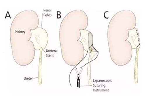 Kidney Stone Treatment